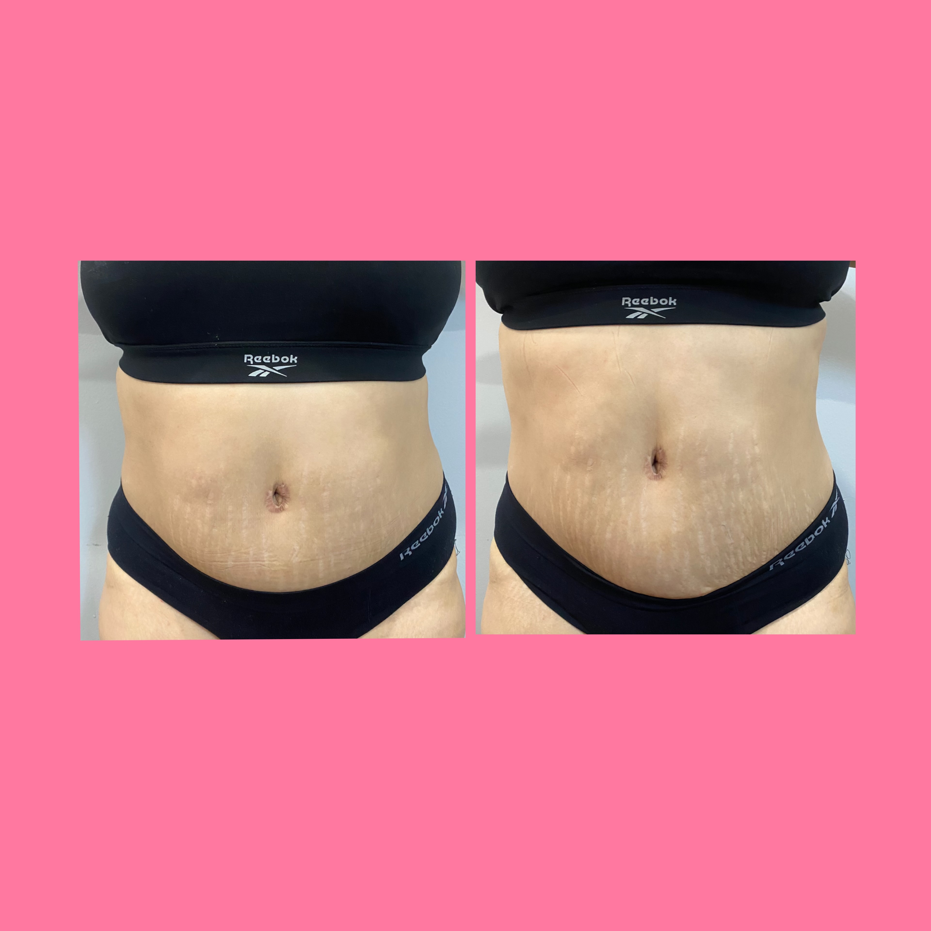 Body Sculpt Treatment