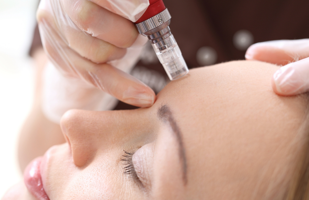 Microneedling (Skinpen) at Glow By Miranda in Phoenix, AZ