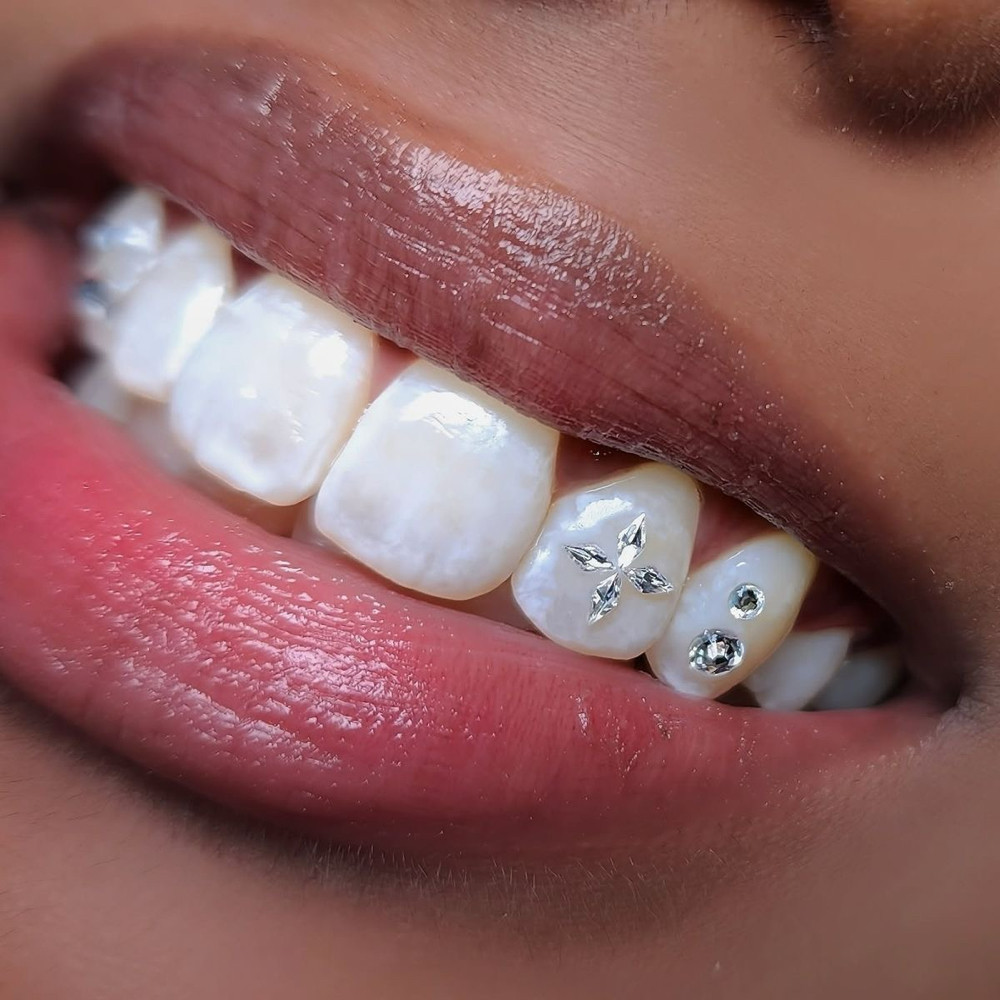 Tooth Gem Replacement