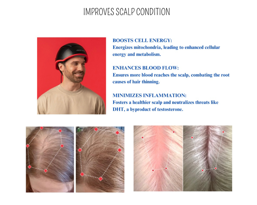 Hair Laser therapy