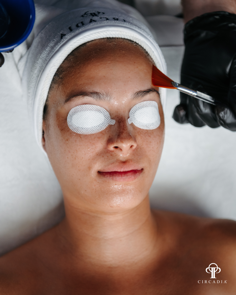 Acne peel