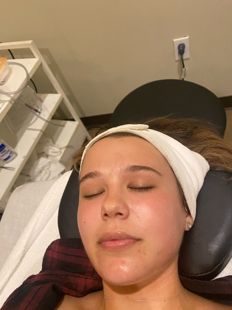 Microdermabrasion Facial