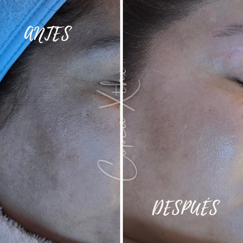 Dermaplane