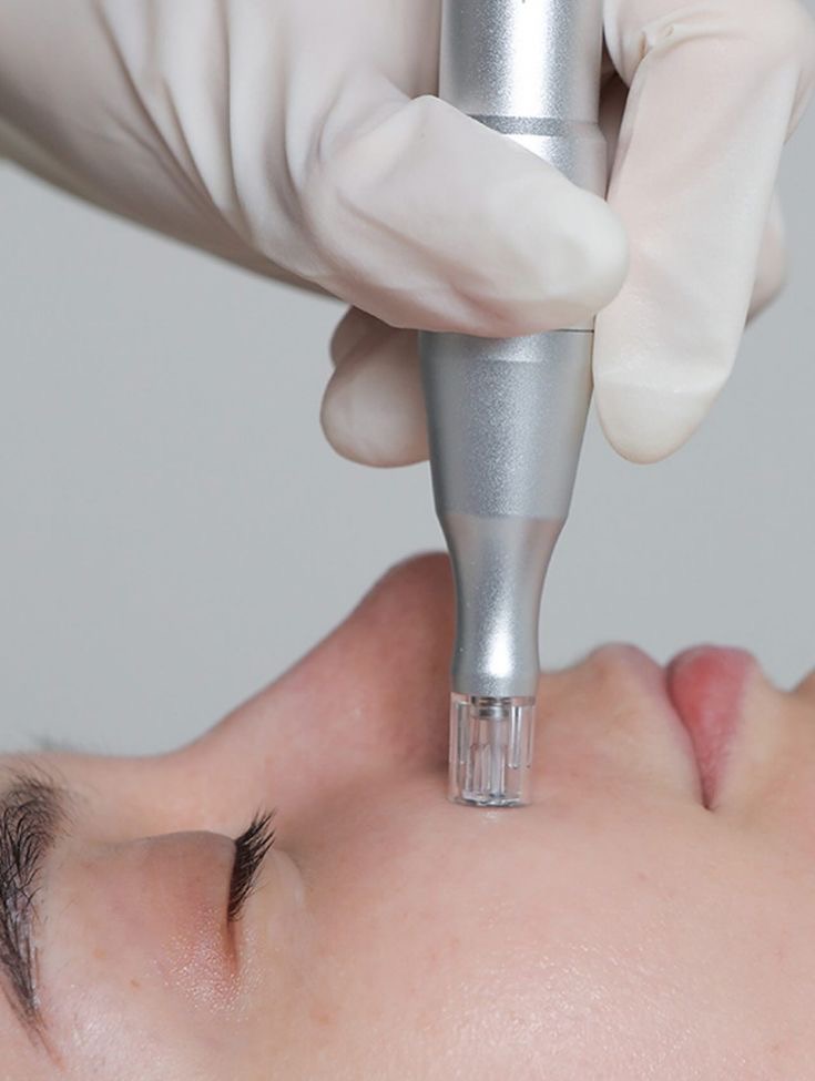 Nano Needling Facial at Luxe Skin by Shay in Hewlett, NY