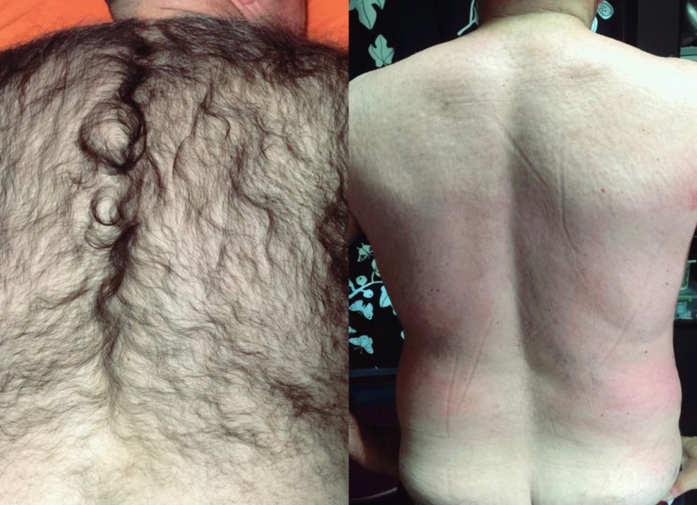 Back Wax (Really Hairy)
