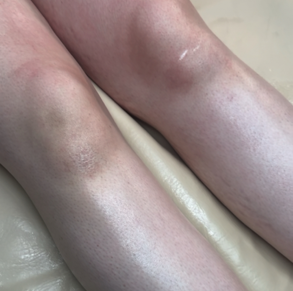 FULL LEG at Lakutis Skin Therapy in Houston, TX