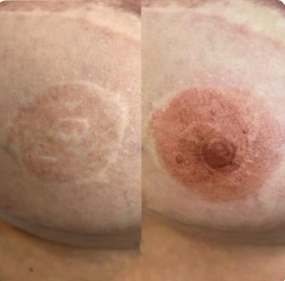 3D Areola Restoration at Studio PrimaVera in Roswell, GA