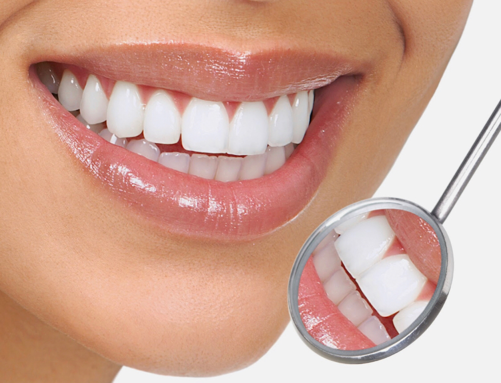 Teeth Whitening Service