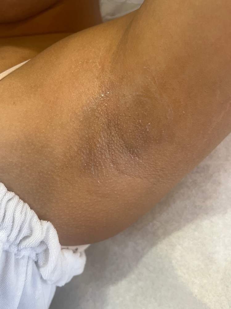 Underarm at Blu Esthetics LLC in Rochester, NY