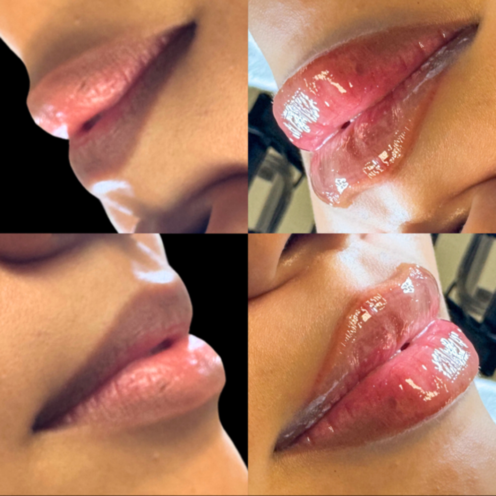 Mini Plump at B’You Aesthetics Lounge in Pharr, TX