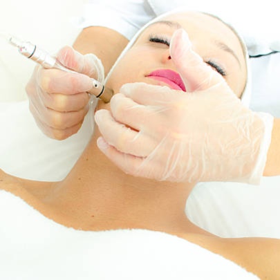 Microdermabrasion Treatment