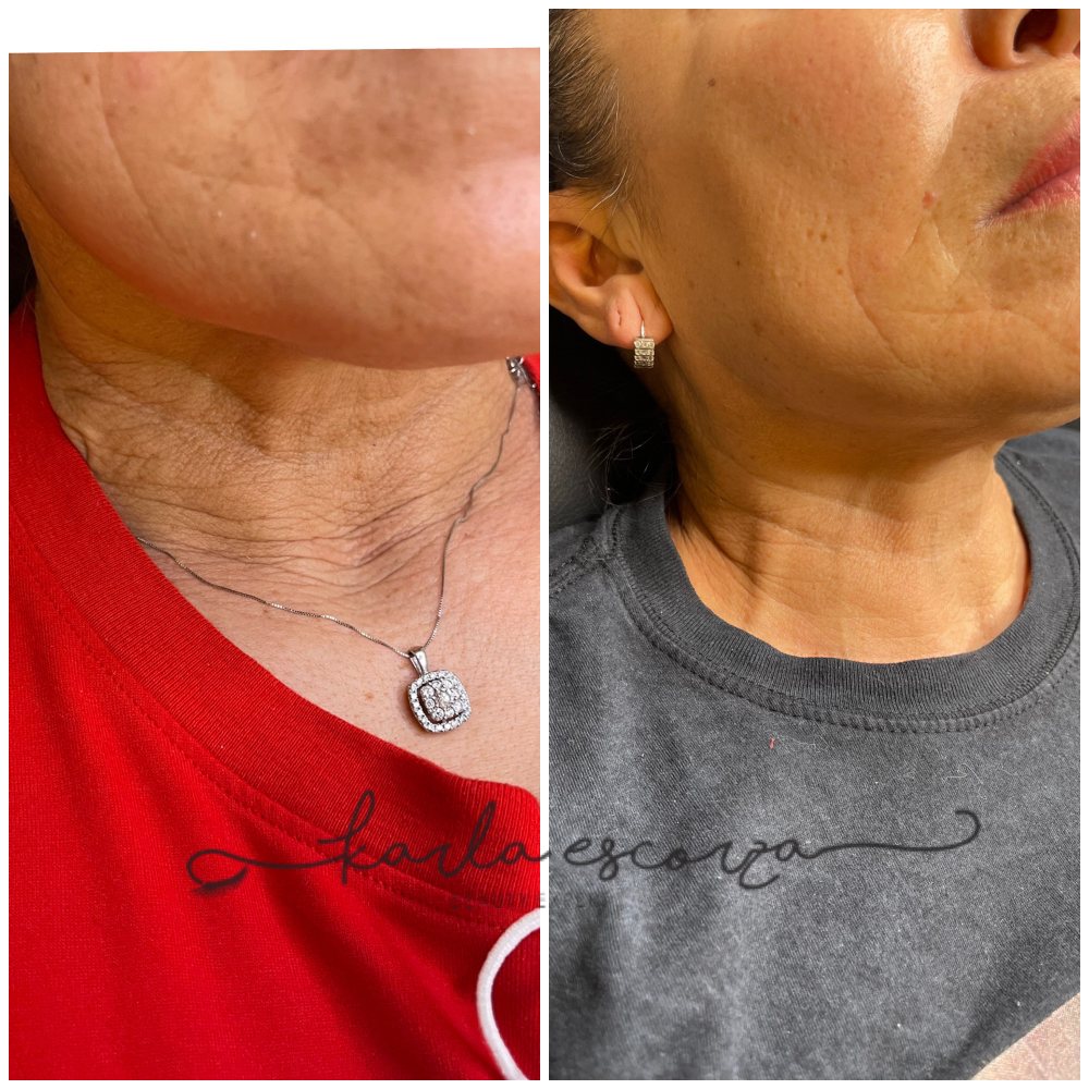 Neck Fibroblast at LASHES AND BROWS By Karla Escorza in Northglenn, CO