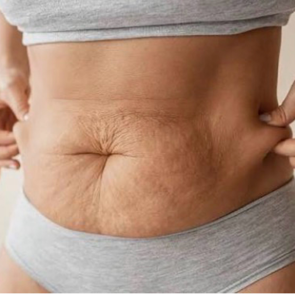 Focused Skin Tighten & Sculpt at Sculpted Body Renewal in Villa Rica, GA