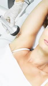 Cavitation- Arms / Bra Bulge