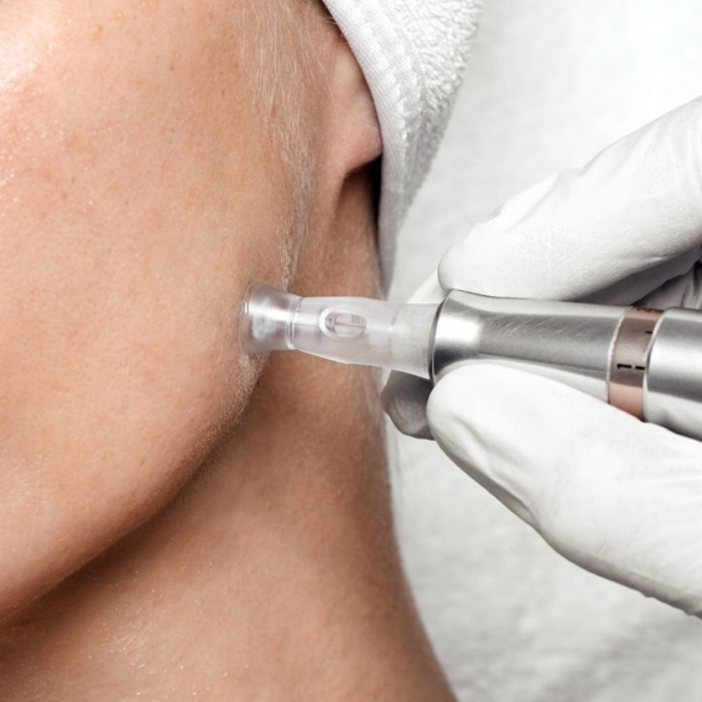 microneedling at KLbeauty in Covington, LA