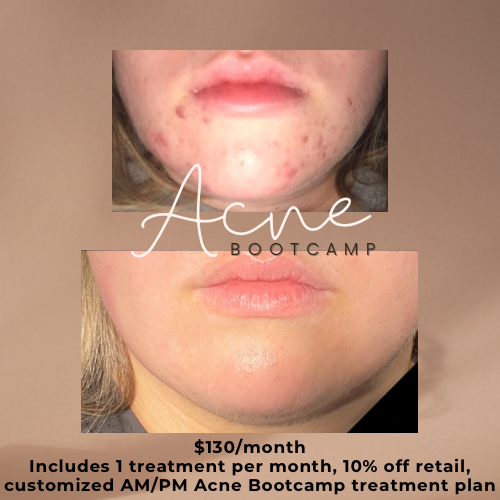 Acne Bootcamp Treatment