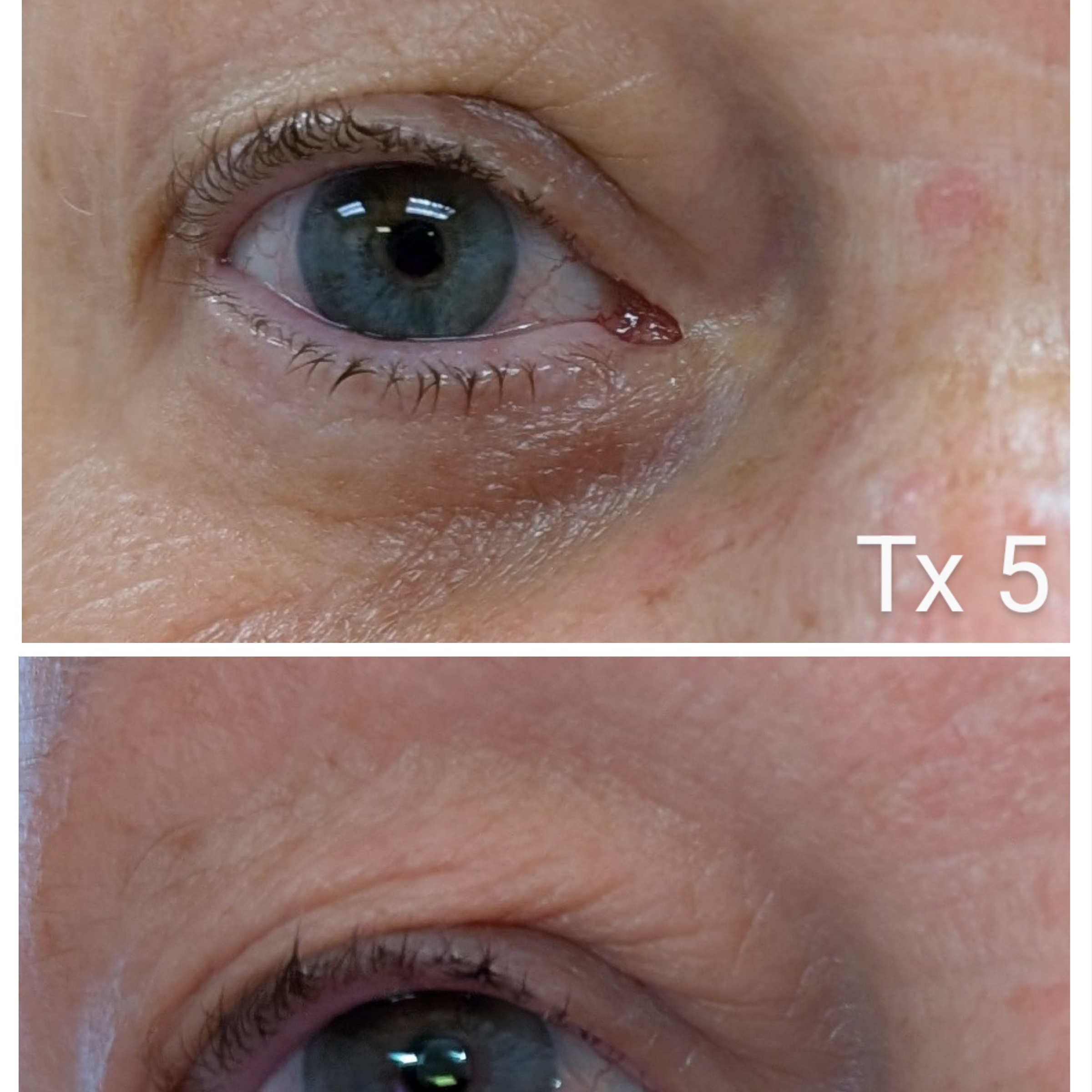 BLEPH & BRIGHTEN LID REJUVENATION at Gorgeous Glow Facial Spa, LLC in Boynton Beach, FL