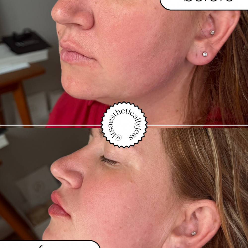 Lip Filler at It's Aesthetically Jess in Swansea, IL