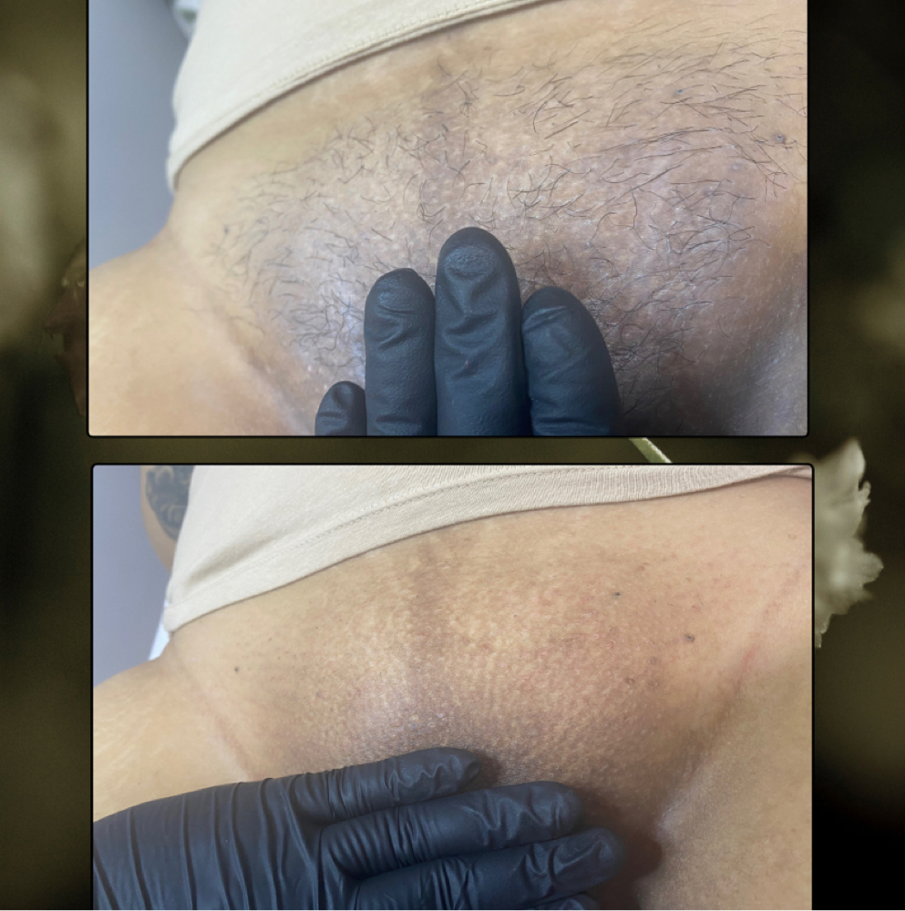 Brazilian Wax at Artemis Esthetics by Lorena LLC in Summit, IL