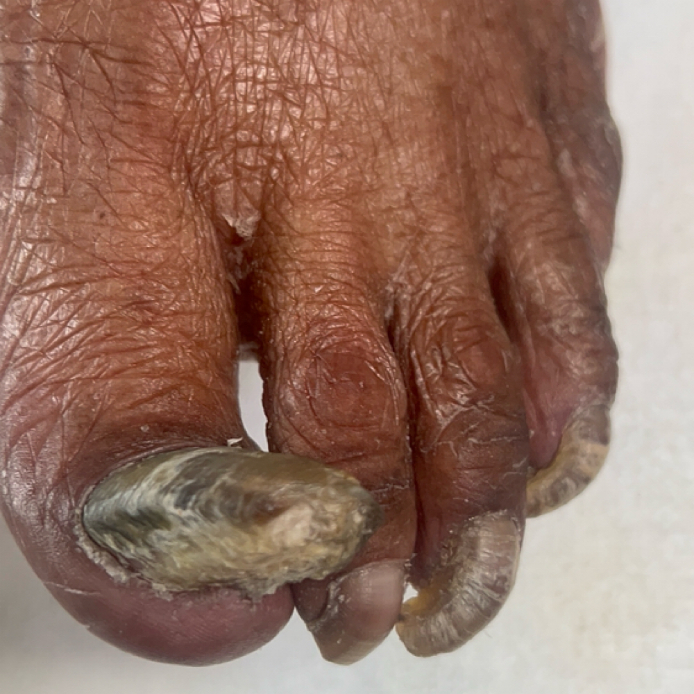 Medical Wellness Pedicure-Stage 4 at Taylor’D Nailz in Ga, GA