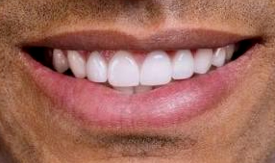 EXPRESS WHITENING 1-4 Shades!