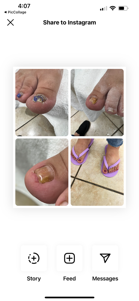 Toenail Reconstruction