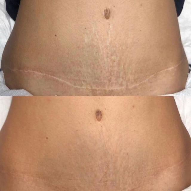 Tummy Tuck Scar Camouflage