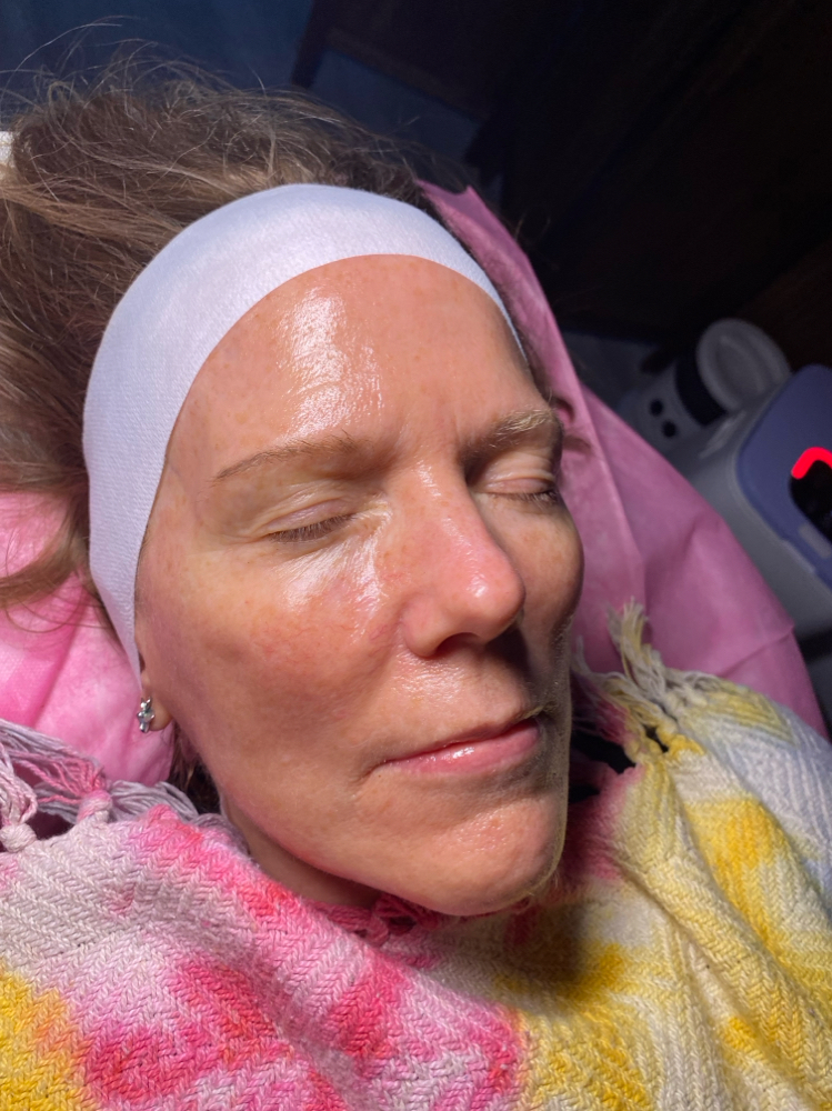 Vita Brite Chemical Peel