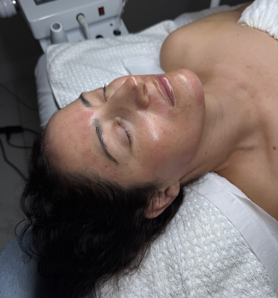 MICRONEEDLING W SALMON DNA