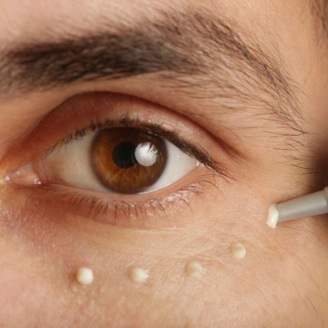 Dark circles & puffiness reduction at Artemix Beauty & Medspa LLC in Tulsa, OK