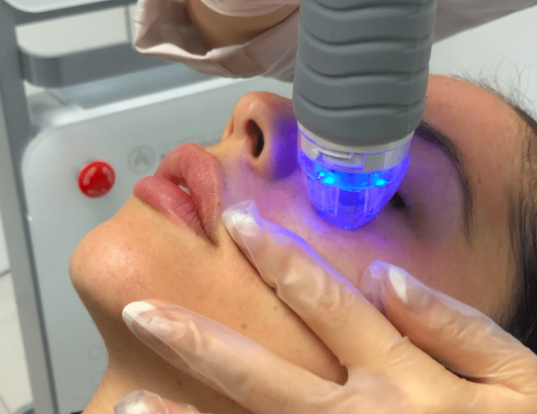 Fractional Microneedling (2 Areas)