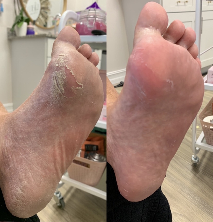 Extensive Callus Treatment