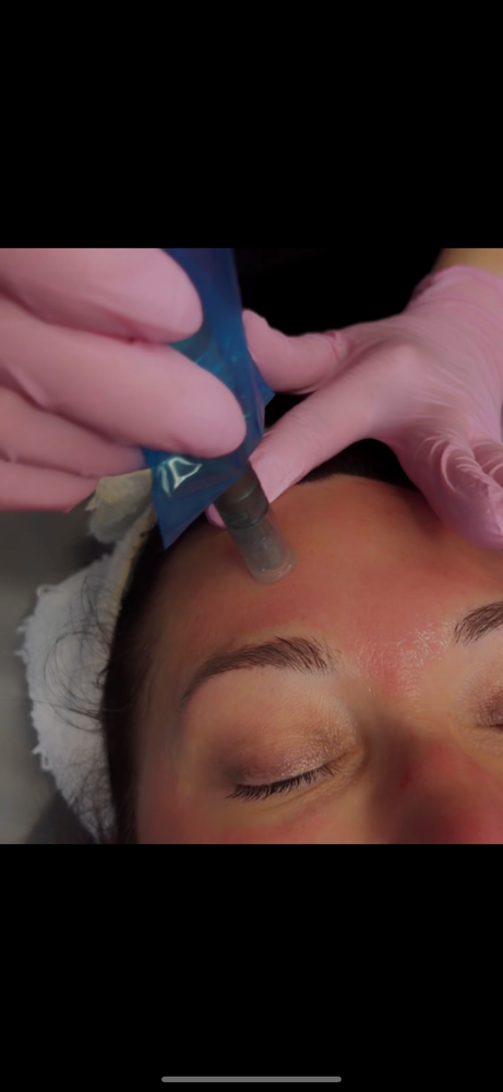 Microneedling (series of 3)