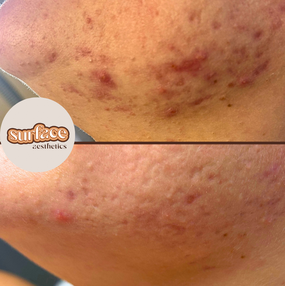 Face Reality Acne Bootcamp Consult at Surface Aesthetics in Jackson, GA