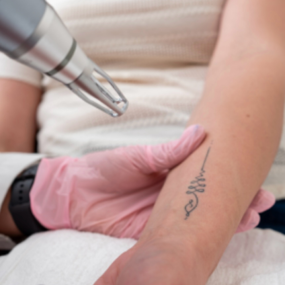 Tattoo Laser Removal at KIMBERLY OSUNA - GLAM STUDIO in Midland, TX