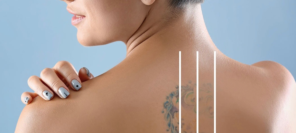 Tattoo Removal
