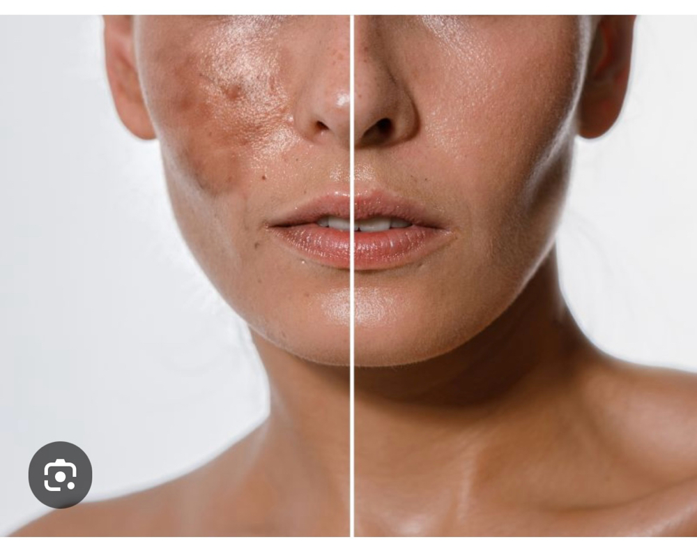 Chemical Peel