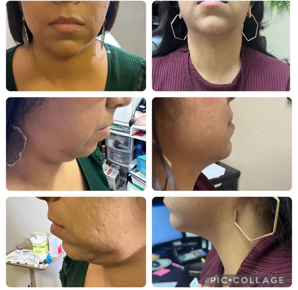 PCDC/KYBELLA- DOUBLE CHIN AREA