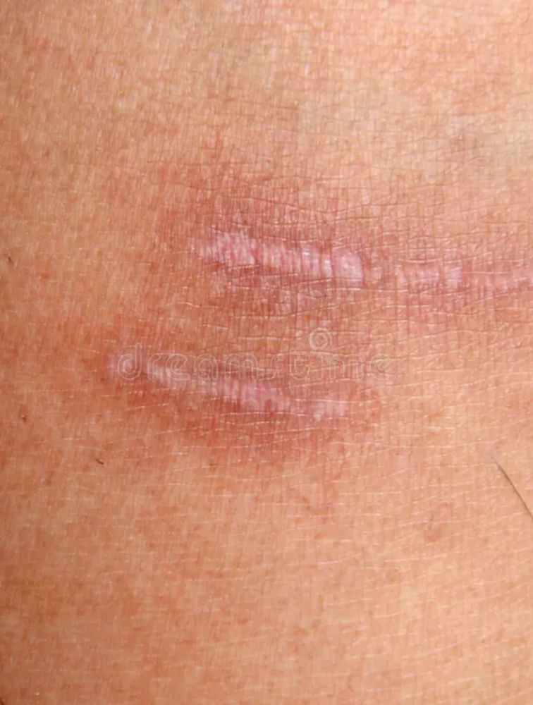 Burn Scar Blending