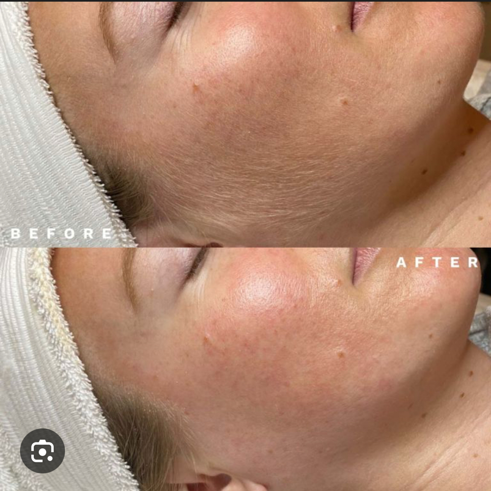 Dermaplaning