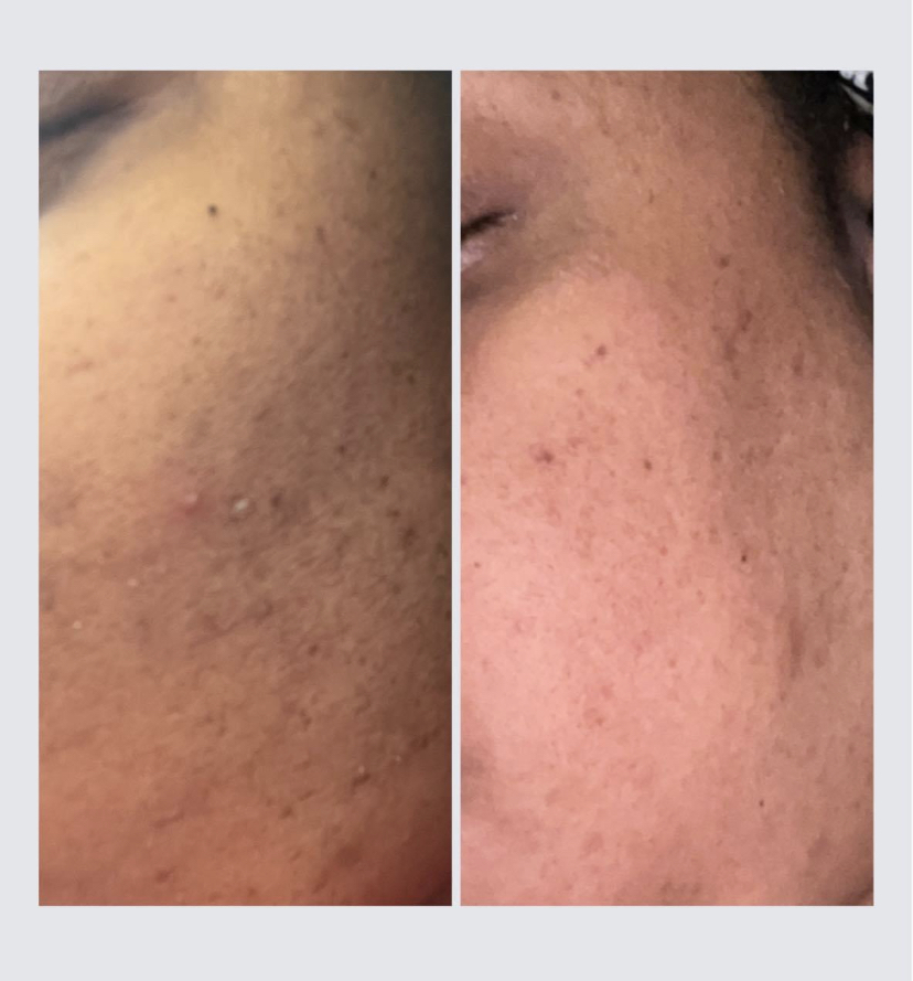 6 Week Glycolic Peel Treatments