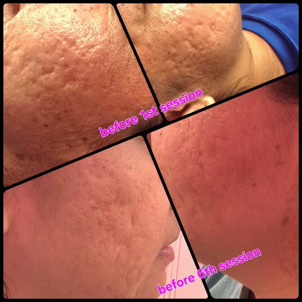 Microneedling at Glass Face Aesthetics LLC in Fort Stockton, TX