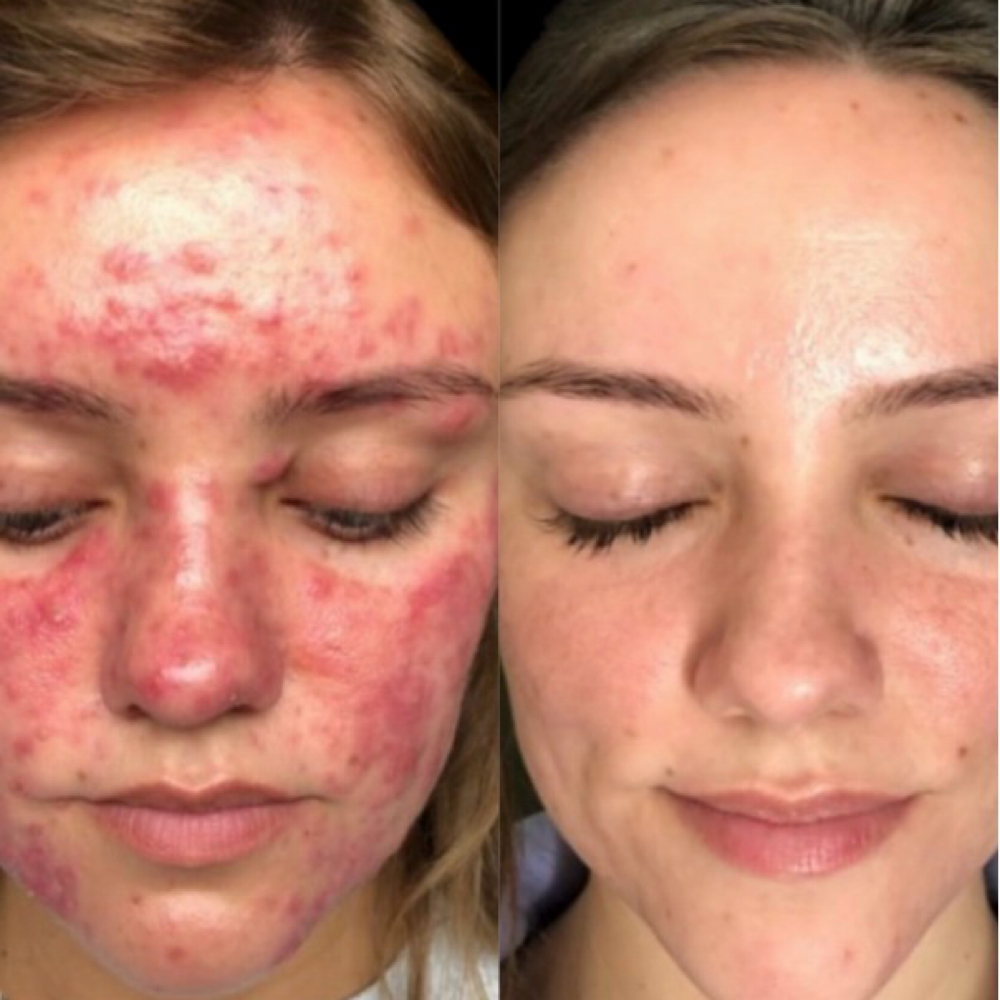 Acne Treatment at Sanazskincenter in Vienna, VA