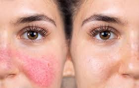 Rosacea Facial