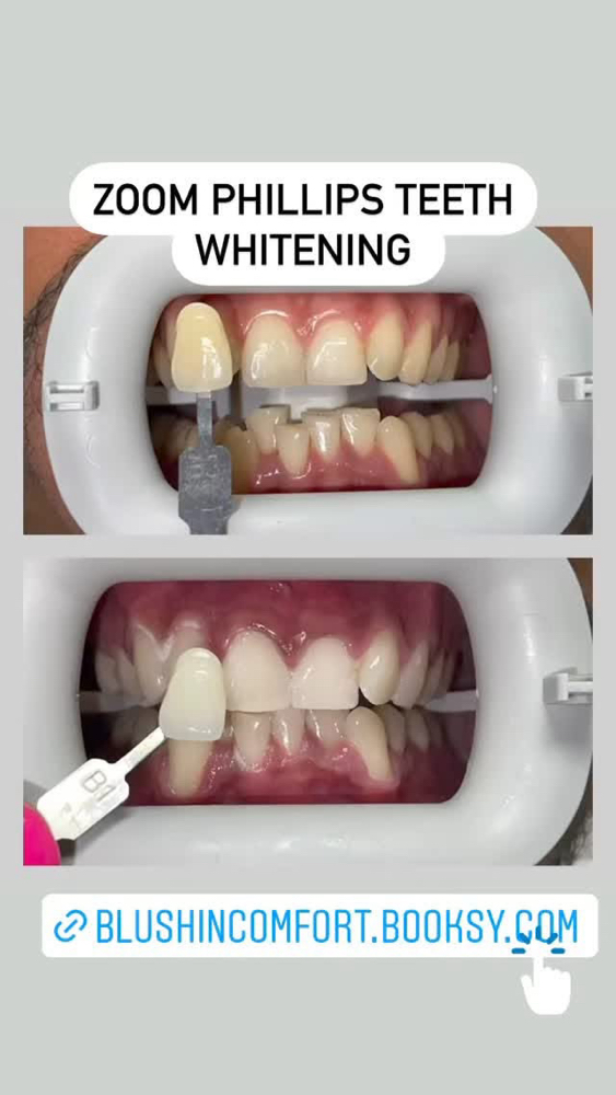 Blush In Comfort Teeth Whitening