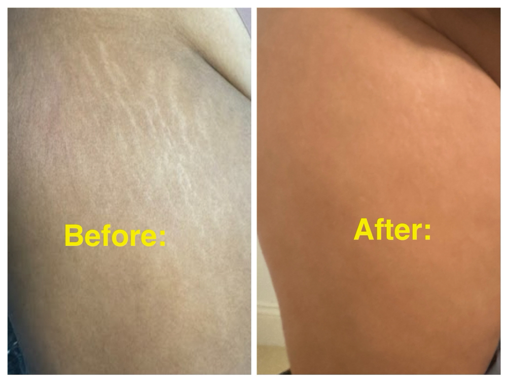 Paramedical Tattooing Medium Area