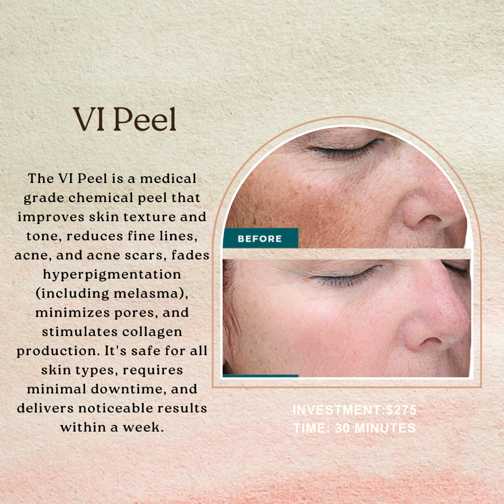 VI peel