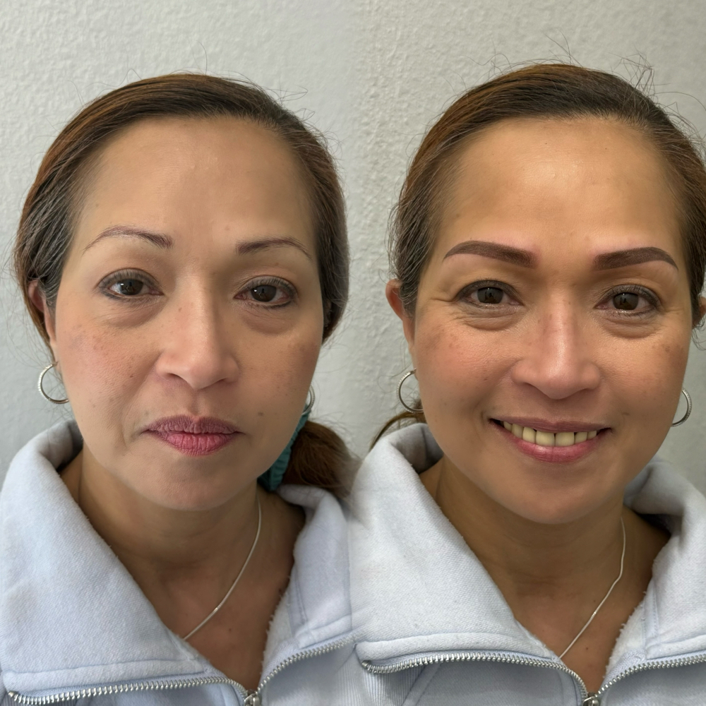 Brows Correction