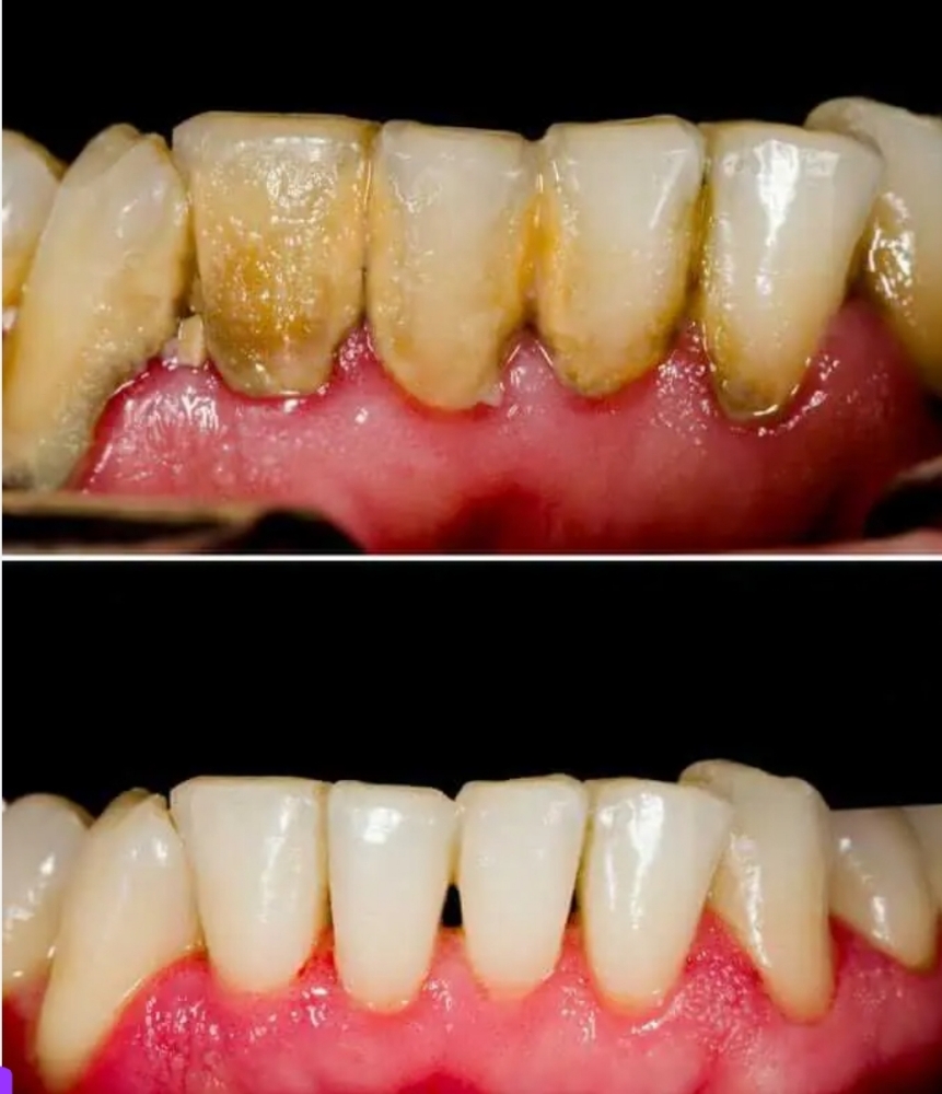 Whitening & Cleaning Combo