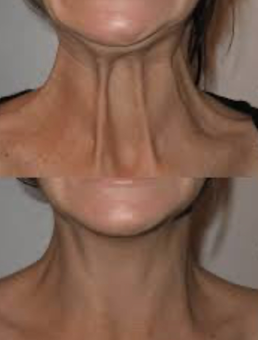 Neck Bands (Platysma)